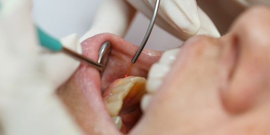 Dental-Laserbehandlung